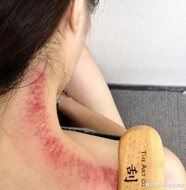 Is It Effective to Scrape Until Bruising in Gua Sha? How Often Can You Do It? Four Things to Know Before Gua Sha