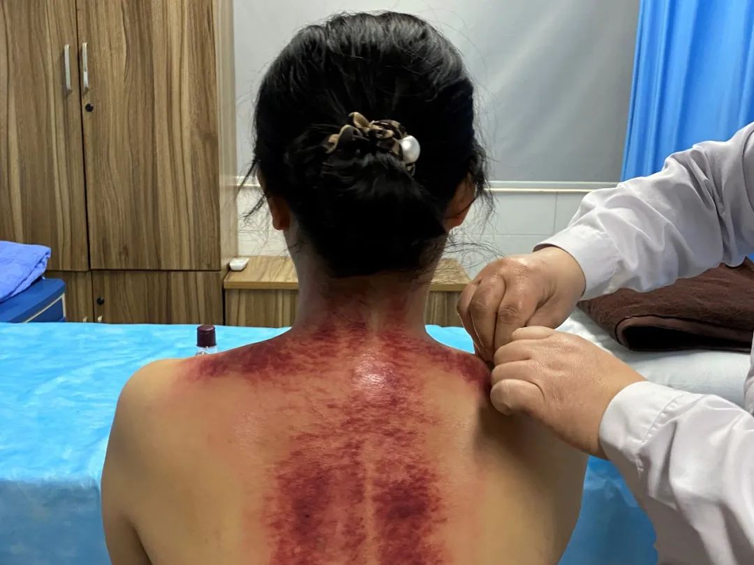 Traditional Chinese Medicine Therapy | 'Gua Sha' for Better Health!