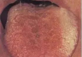 Understanding Tongue Diagnosis in Traditional Chinese Medicine (with Tongue Diagnosis Illustrations)