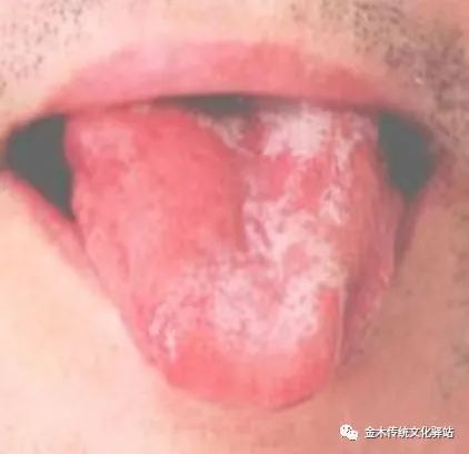 Tongue Diagnosis in Traditional Chinese Medicine: Characteristics of Tongue Coating