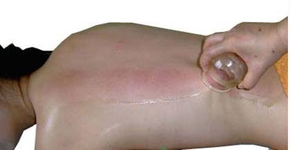 Cupping Therapy: Unblocking Meridians, Promoting Qi and Blood Circulation!