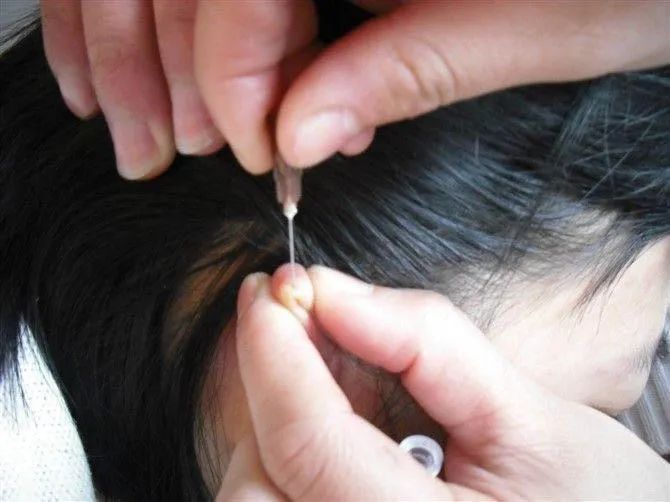 Immediate Effects of Bloodletting Therapy