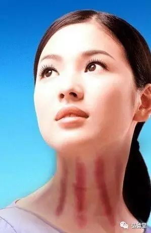 The Principles and Effects of Gua Sha