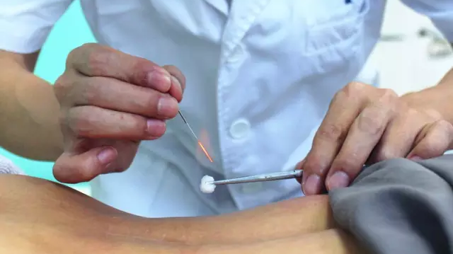 Understanding Fire Needle Therapy