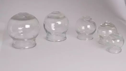 The Marvelous Cupping Therapy in Traditional Chinese Medicine: Many Benefits, but Not for Everyone!