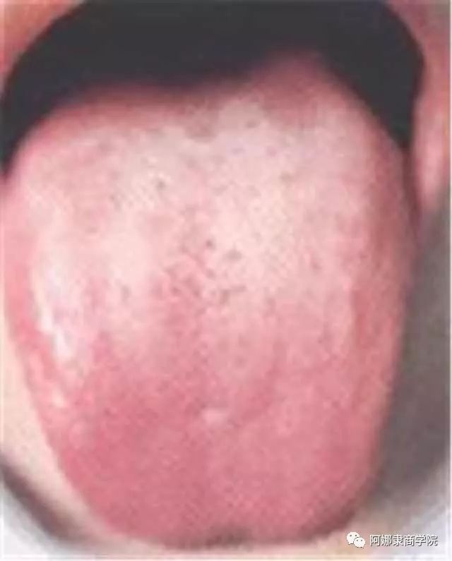 A Comprehensive Guide to 22 High-Definition Tongue Diagnosis Images: Understand Diseases Through Tongue Observation!