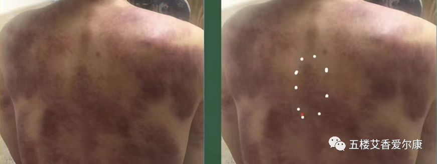 Summary of Common Diseases and Gua Sha Treatment Plans Including Human Reflex Maps, Contraindications, and Diagnosis of Sha Patterns