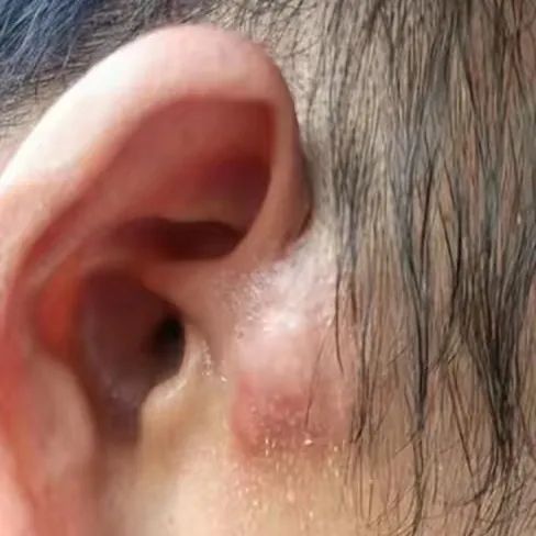 Fire Needle Therapy in Traditional Chinese Medicine for Treating Folliculitis, Boils, and Abscesses