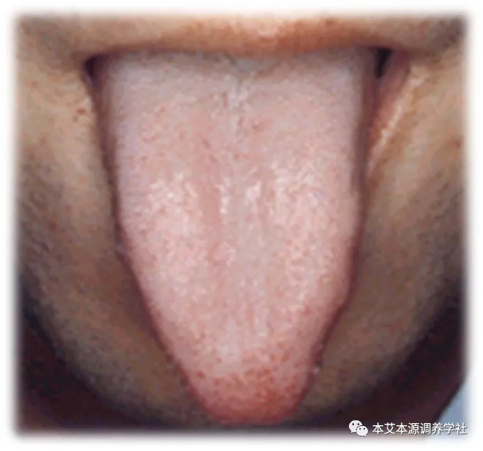 Tongue Diagnosis Series 3: Precise Differentiation of Tongue Coating, Quality, and Shape