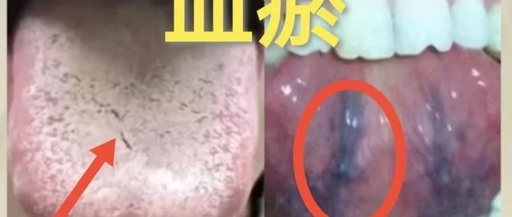 Three Strategies to Alleviate Stagnation, Blood Deficiency, and Yang Deficiency in TCM