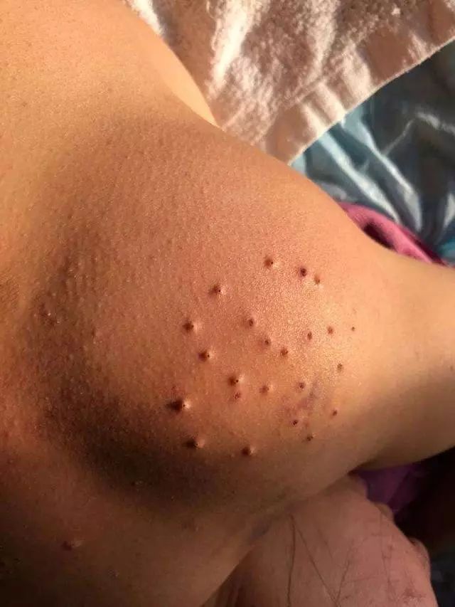 Fire Needle Therapy for Large Lipomas