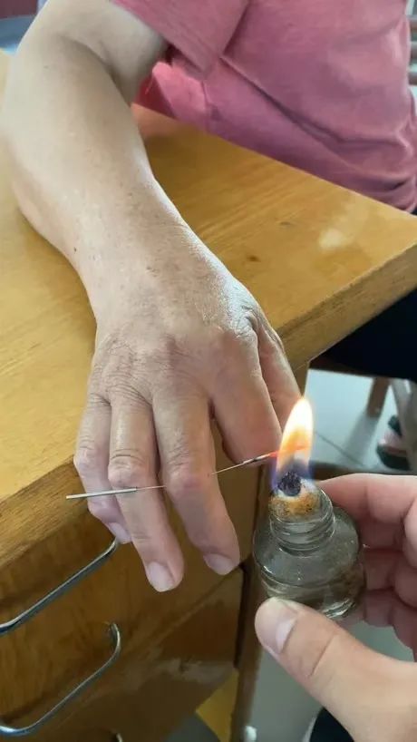 Understanding Fire Needle Therapy in Traditional Chinese Medicine