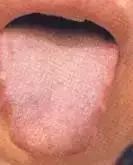 Comprehensive Guide to Tongue Diagnosis: Learn How Your Tongue Reflects Your Health!