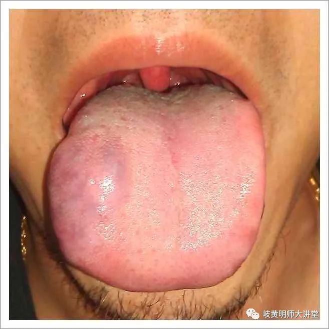 Traditional Chinese Medicine Tongue Diagnosis: Illustrated Guide to 14 Types of Tongue Shapes and Qualities