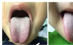 Tongue Coating Diagnosis in Traditional Chinese Medicine