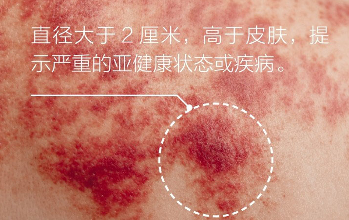 Understanding the Signs of Gua Sha: Master These 5 Colors and 4 Shapes for Better Health