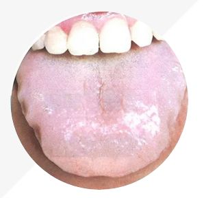 Understanding Tongue Diagnosis in TCM: Insights into Health from Tongue Appearance (Part 2)