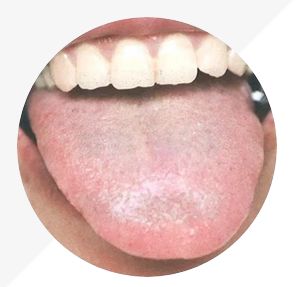 Understanding Tongue Diagnosis in TCM: Insights into Health from Tongue Appearance (Part 2)