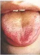 Comprehensive Guide to Tongue Diagnosis: Learn How Your Tongue Reflects Your Health!