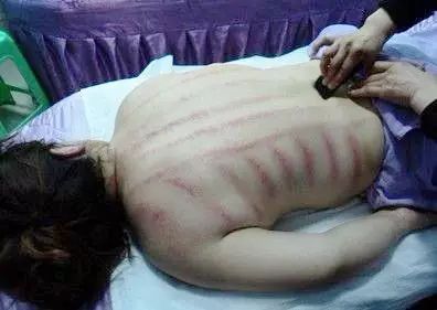 Gua Sha, Massage, and Bloodletting: A Cautionary Tale from Nanning
