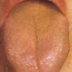 Understanding Tongue Diagnosis in Traditional Chinese Medicine (with Tongue Diagnosis Illustrations)