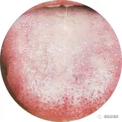 What Can Tongue Quality and Coating Reveal? The Significance of Tongue Diagnosis