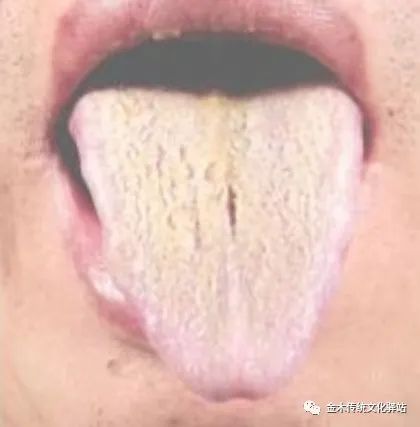 Tongue Diagnosis in Traditional Chinese Medicine: Characteristics of Tongue Coating