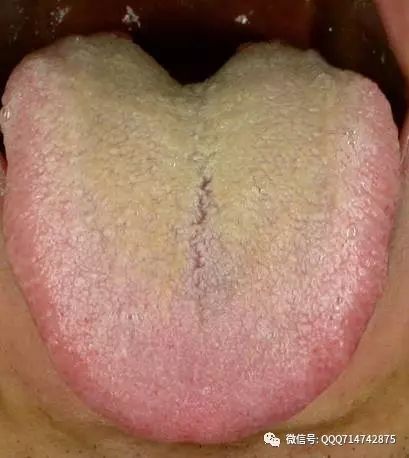 How to Regulate Phlegm-Damp Constitution Without Supplementation?