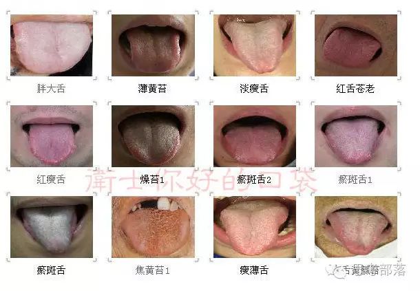 Comprehensive Guide to Tongue Diagnosis (8): 72 Types of Tongue Diagnosis Charts