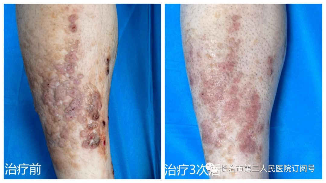 The Power of Fire Needling in Treating Skin Diseases