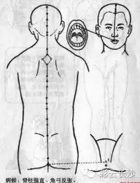 Classic Acupuncture Points: The Eight Extraordinary Meridians
