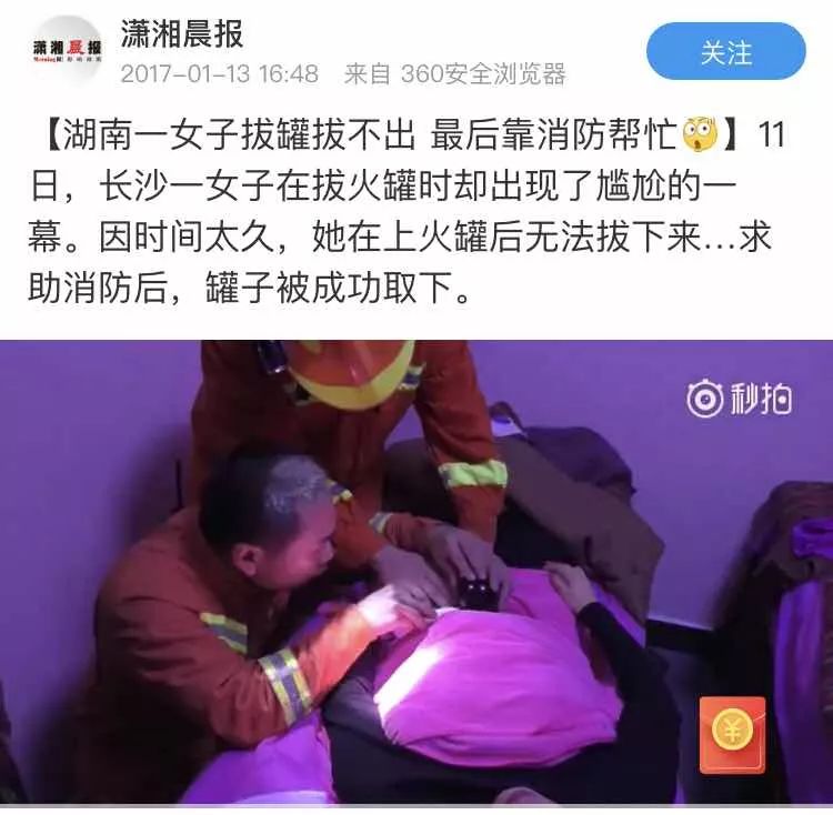Cupping Tragedy Reoccurs! A Woman in Xuzhou Suffers Burns from Cupping; Essential Precautions You Must Know