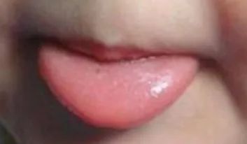 How to Observe Tongue Coating to Reflect Your Health