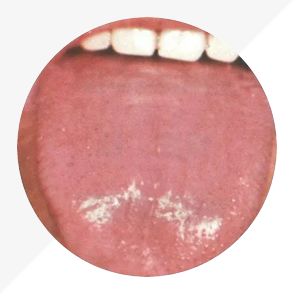 Understanding Tongue Diagnosis in TCM: Insights into Health from Tongue Appearance (Part 2)