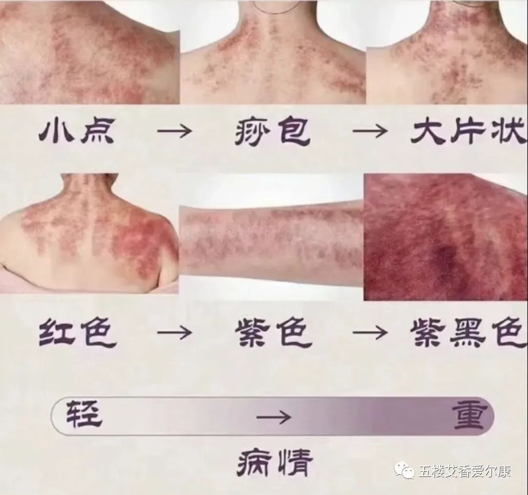 Summary of Common Diseases and Gua Sha Treatment Plans Including Human Reflex Maps, Contraindications, and Diagnosis of Sha Patterns