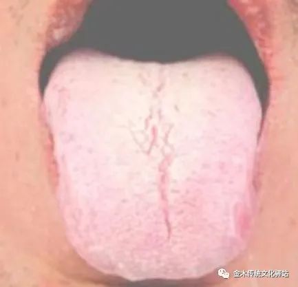 Tongue Diagnosis in Traditional Chinese Medicine: Tongue Coating