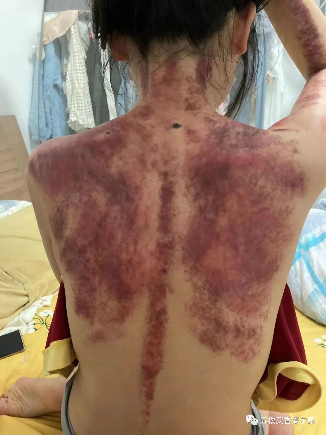Summary of Common Diseases and Gua Sha Treatment Plans Including Human Reflex Maps, Contraindications, and Diagnosis of Sha Patterns