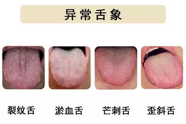 Observing the Tongue in Traditional Chinese Medicine: Tongue Color Changes Indicate Stroke!