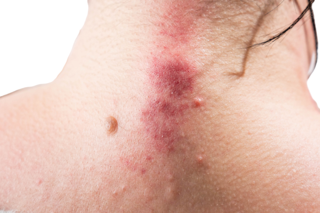 Gua Sha: A Gentle Scraping Technique to Regulate Qi and Blood, Boost Immunity!