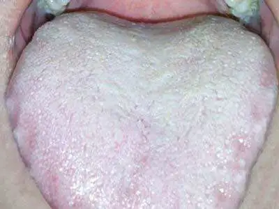 Four Tongue Coating Colors Revealing Your Body Condition!