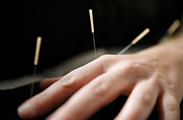 Balancing Yin and Yang in the Body: Preventing Disease and Treating Existing Conditions with Traditional Chinese Medicine Acupuncture