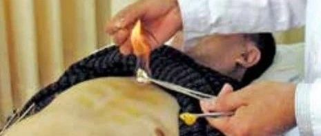 Traditional Chinese Medicine Acupuncture: The Art of Fire Needle Therapy
