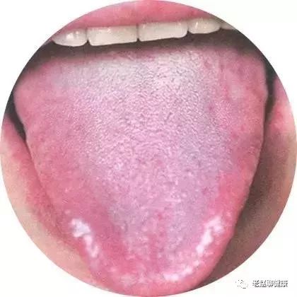 Learn Quick Ways to Observe Tongue Quality and Coating to Understand Your Health and Diseases!