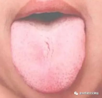 Tongue Diagnosis in Traditional Chinese Medicine: Tongue Coating
