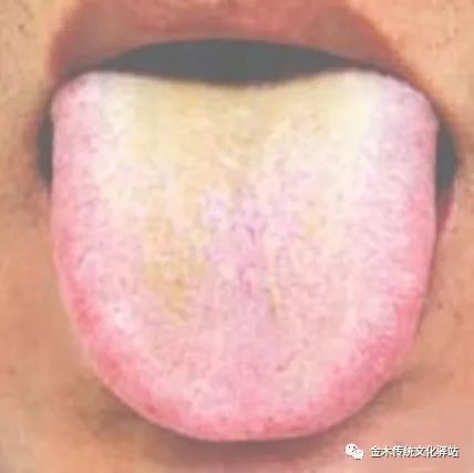Tongue Diagnosis in Traditional Chinese Medicine: Characteristics of Tongue Coating