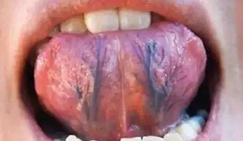 Tongue Coating Diagnosis in Traditional Chinese Medicine
