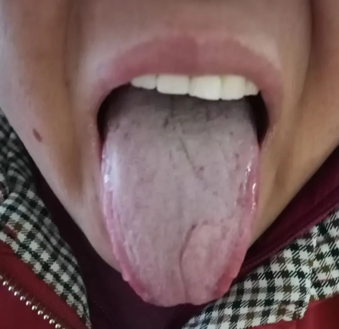 A Case of Unexpected Recovery from Urinary Incontinence Following a Common Cold