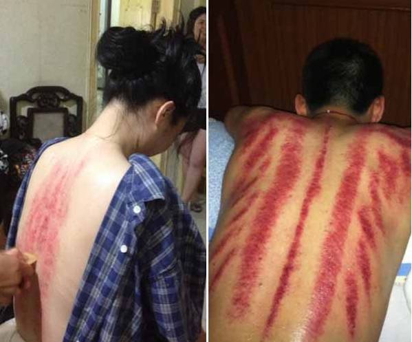 The Eight Most Common Techniques of Gua Sha and Comprehensive Analysis of Sha Patterns