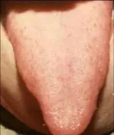 Tongue Diagnosis - Illustrated Guide to Tongue Manifestations