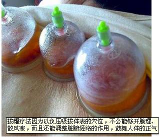 The Most Important Aspects of Cupping Therapy Revealed!